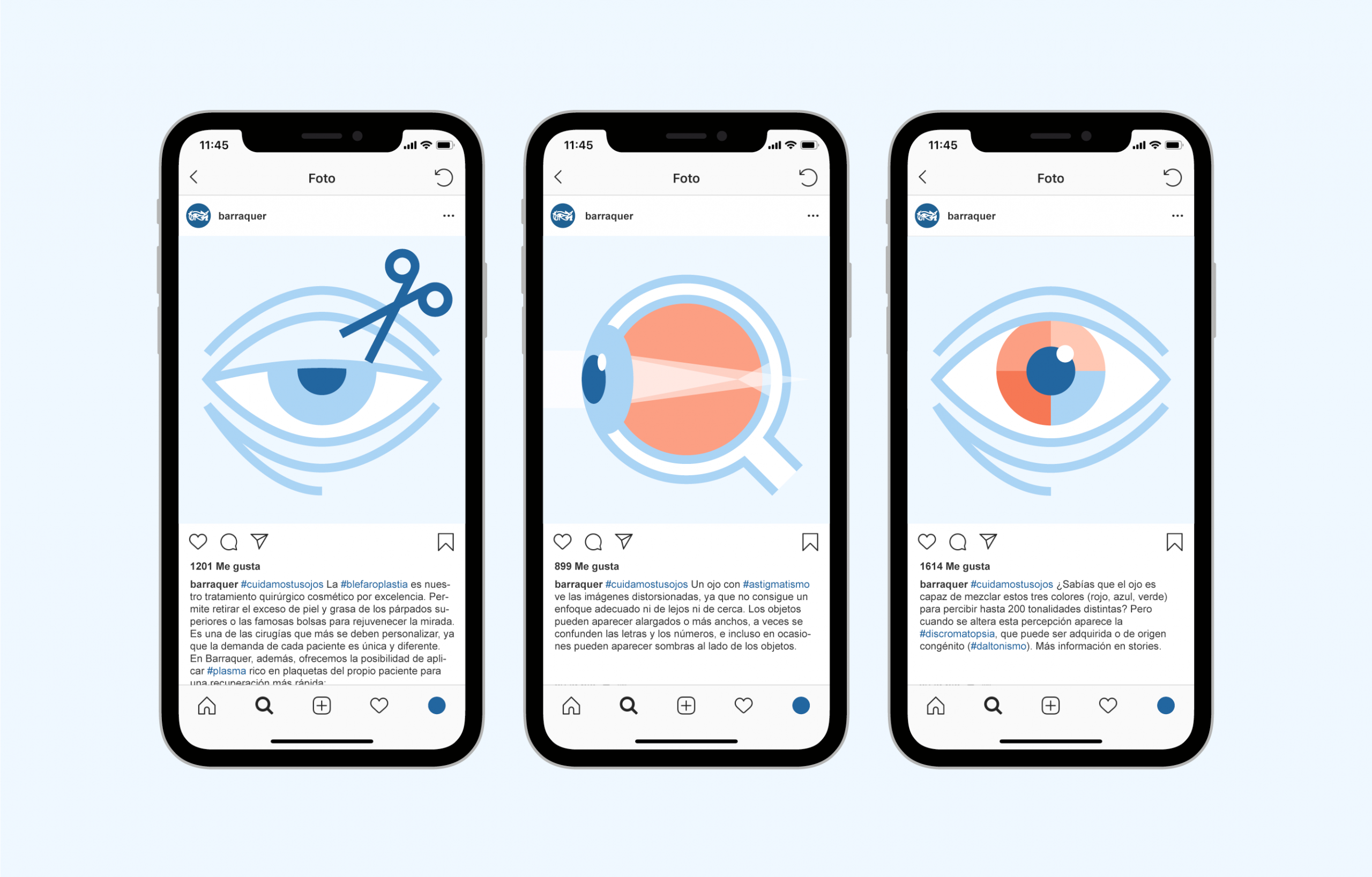 forma_barraquer_eyes_07